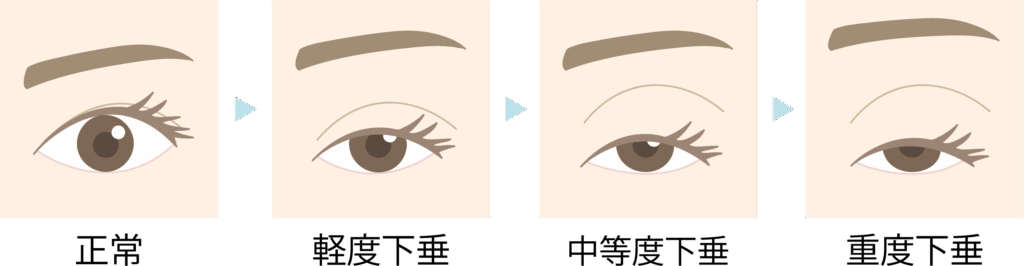 眼瞼下垂の症状別イラスト